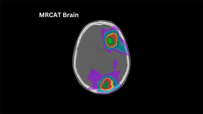 MRCAT Brain