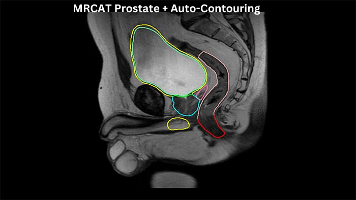 MRCAT Prostate + Auto-Contouring